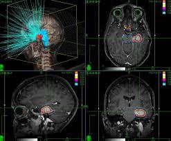 Stereotactic Radiosurgery